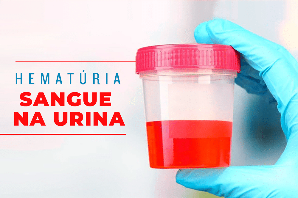 Sangue na urina – Hematúria